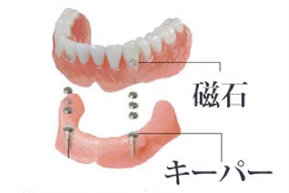 入れ歯固定力向上オプション